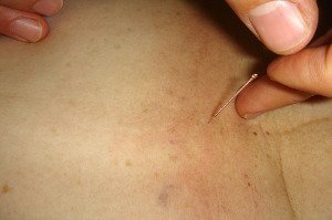 zdraví, nemoci, alternativní medicína, akupunktura
