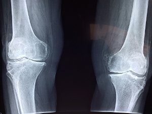 Artróza kolenního kloubu a možnosti její léčby
