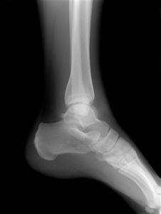 Osteoporóza láme kosti