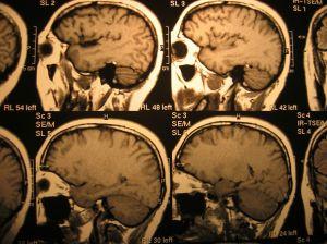 Parkinsonova choroba postihuje častěji muže
