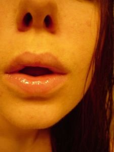 Infekce ústní dutiny - příčiny, léčba, prevence