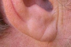 Jak vypadají vaše uši? Vrásky na nich jsou důvod k preventivní prohlídce!