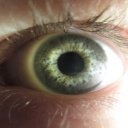 Prasklá cévka v oku nám může zachránit život